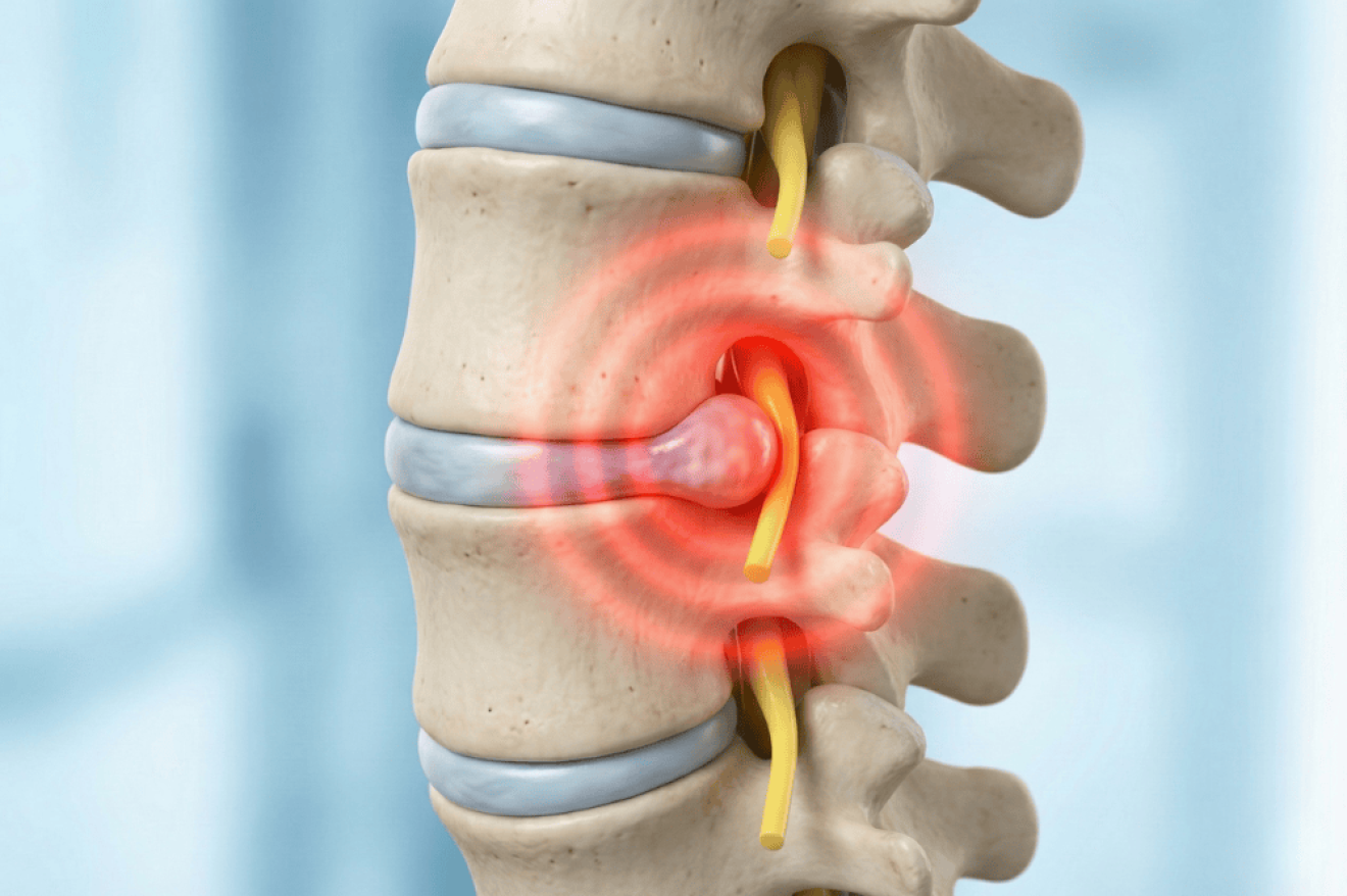 หมอนรองกระดูก