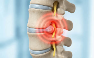 ลดปวดทันที! 3 อาหารต้องห้าม สำหรับคนเป็นหมอนรองกระดูกทับเส้นประสาท